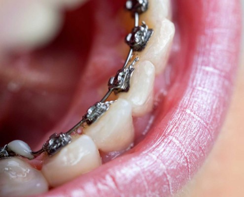 lingual-braces-orthosmile-close-up